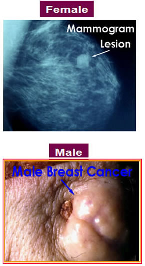 Breast cancer images